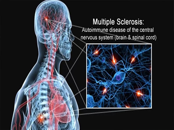 The Role of Cannabis in the Treatment of Multiple Sclerosis...